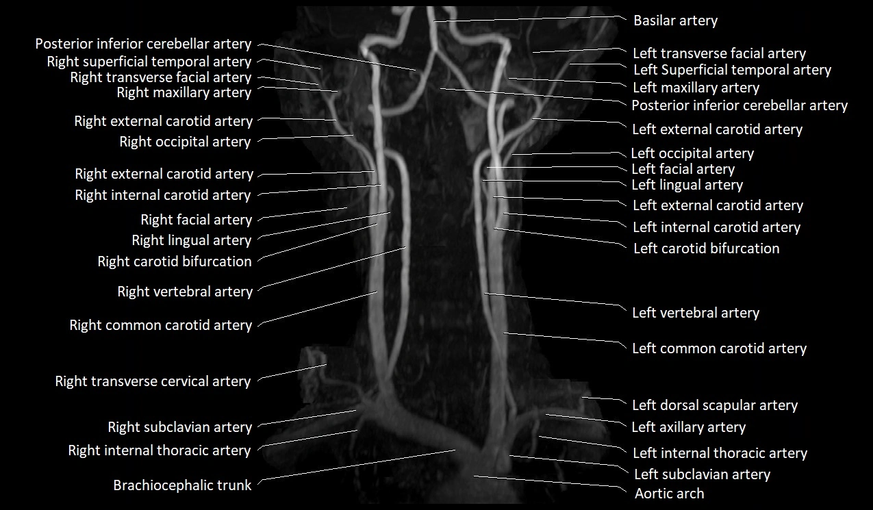 MRA neck carotid arteries labeled anatomy image MIP 3D image 5.webp